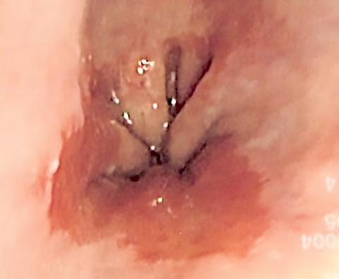 바렛 식도의 내시경 사진. 식도 점막이 검게 혀처럼 튀어 나와 있다. 조직검사 결과 식도 점막이장의 상피처럼 변했다. Credit : Wikimedia Commons / Samir