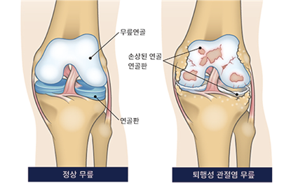 첨단재생의료 치료제로 손상된 연골의 재생이 가능할까요?