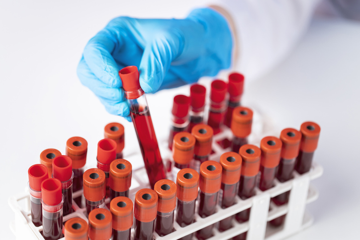 암세포가 흘린 DNA 조각으로 췌장암을 조기에 진단하다