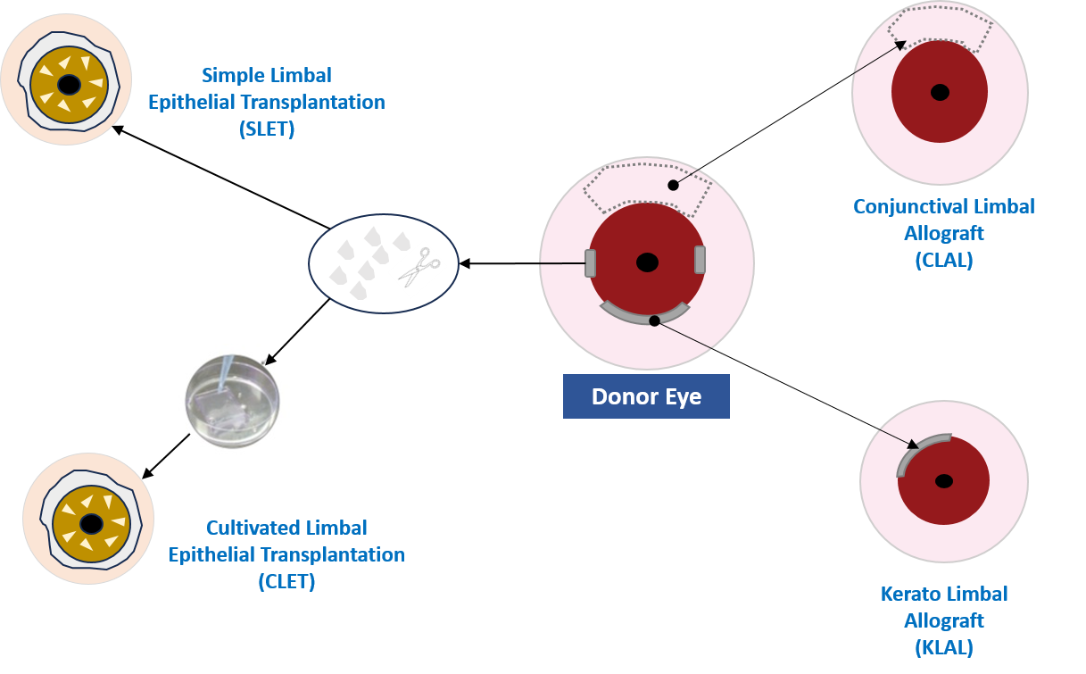 그림 2. 윤부줄기세포결핍증(LSCD)을 치료하기 위한 수술적 방법 (참고문헌; The Ocular Surface, Volume 14, Issue 3, 2016, Pages 350-364, ISSN 1542-0124, https://doi.org/10.1016/j.jtos.2016.02.006.) ⓒKFRM푸름이야기