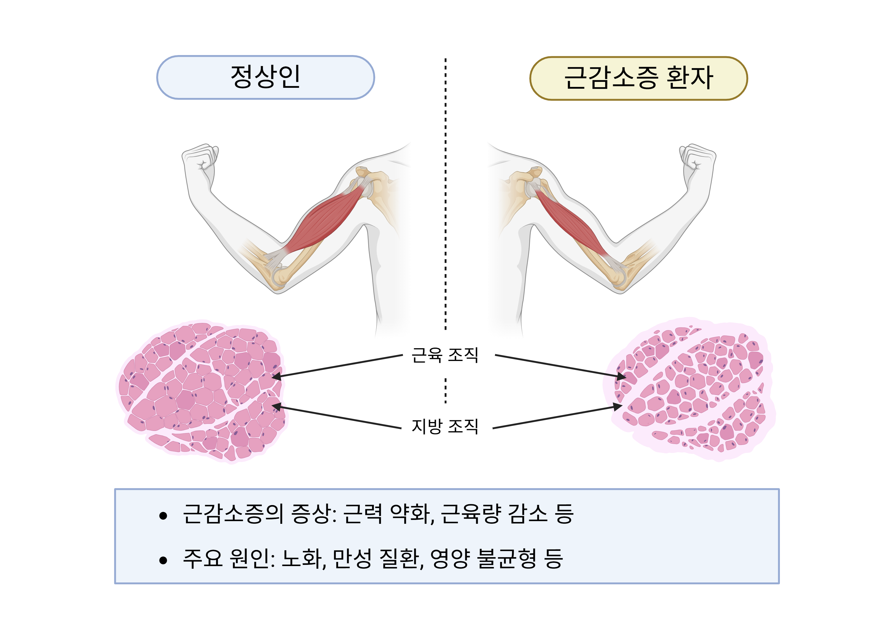 그림 1. 근감소증의 증상과 주요 원인 ⓒCreated in BioRender. Kim, H. (2025) https://BioRender.com/oy18qfh