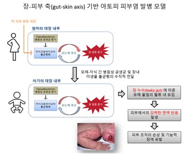 이번 연구에서 제시한 아토피 피부염 발병 모델 ⓒ김희남 교수 제공