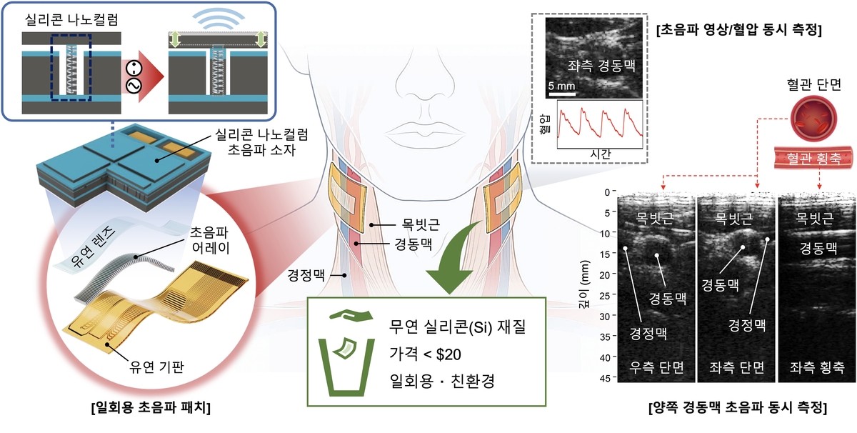 친환경 실리콘 나노 기둥을 이용한 일회용 초음파 패치. 친환경 실리콘 나노 기둥을 이용한 일회용 초음파 패치를 이용해 양쪽 경동맥의 초음파 영상/혈압을 동시에 측정한 결과. 납이 들어있지 않은 실리콘 나노 기둥을 스프링으로 이용해 초음파 소자를 구현했고, 이를 통해 초음파 영상을 만들 수 있는 유연 초음파 어레이 패치를 만들었다. 이런 일회용 초음파 패치를 사람 목 양쪽에 붙여 경동맥, 경정맥의 혈관을 관측하고 여기서 나오는 혈압을 동시에 측정했다. ⓒKIST 제공