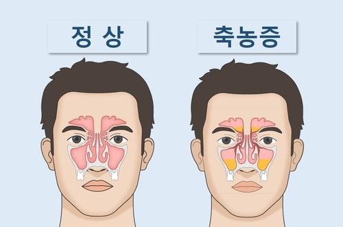 만성 부비동염-부비동에 고름 ⓒ하나이비인후과병원 제공