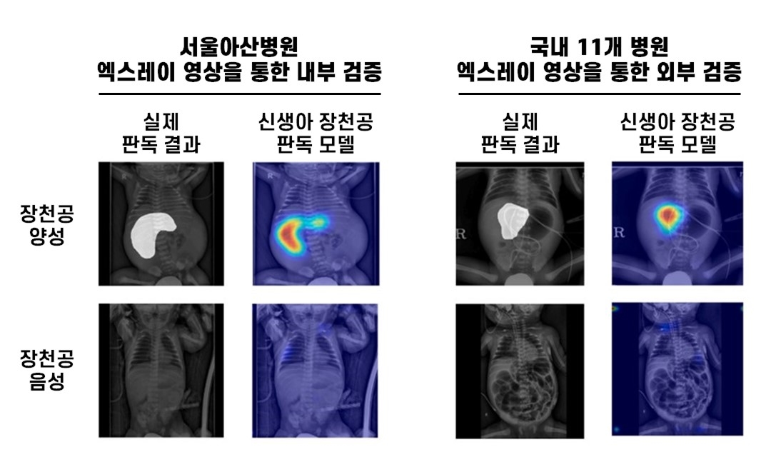 신생아 장 천공 AI 판돌 모델 ⓒ 서울아산병원 제공