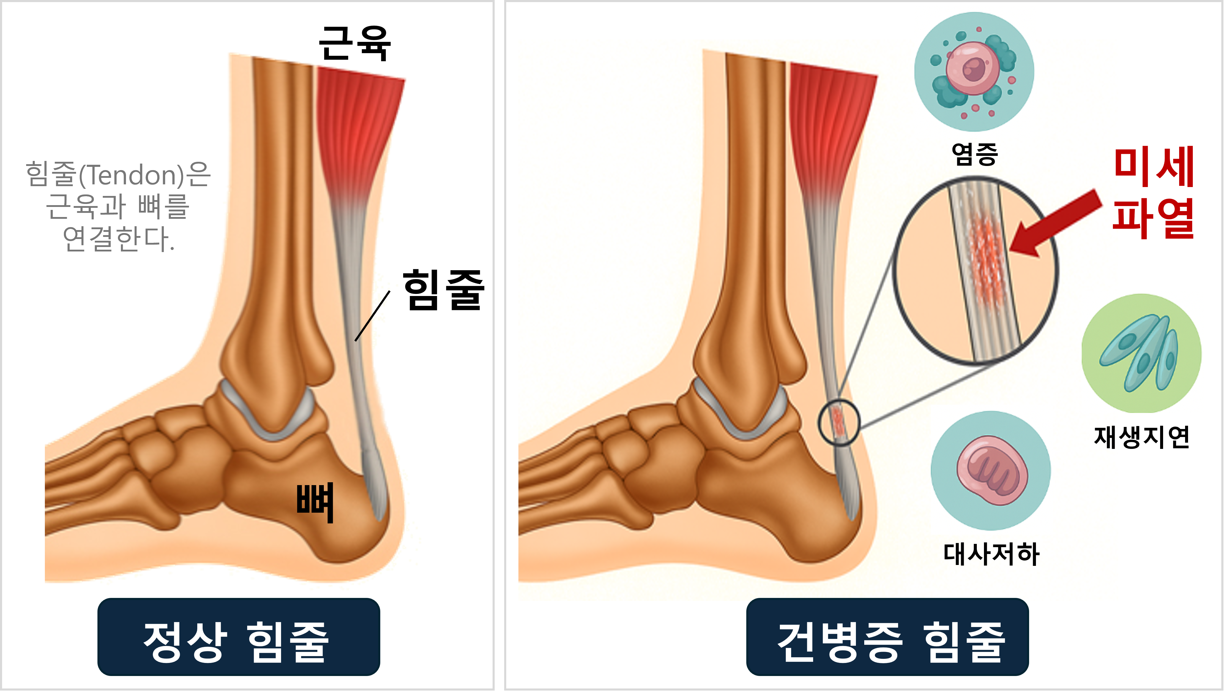 건강한 미토콘드리아를 활용한 재생 치료, 세포 속 에너지로 힘줄을 살리다.