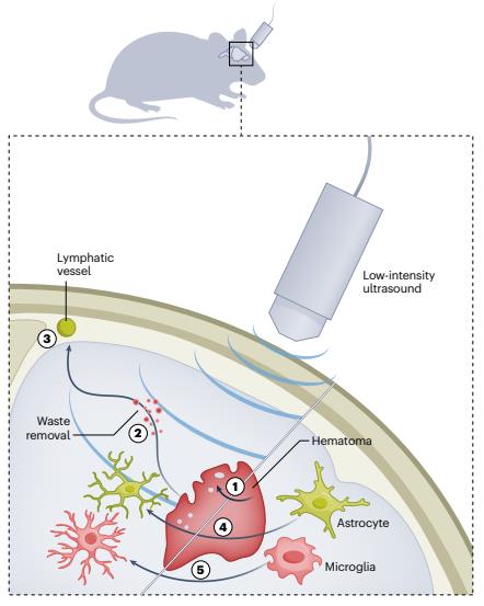 저강도 초음파를 이용한 출혈성 뇌졸중 쥐의 뇌 노폐물 제거 메커니즘. 두가지 형태의 뇌출혈(지주막하 출혈-뇌내/뇌실질 출혈)로 뇌졸중을 유도한 생쥐 모델의 뇌에 주파수 1㎒의 저강도 초점 초음파(LIFU)를 하루 20분씩 3차례 가하는 치료를 한 결과 손상 부위의 적혈구가 대조군보다 55~65% 감소하고 혈종 부피는 약 58% 줄어든 것으로 나타났다. 제거된 적혈구는 심경부 림프절에서 검출, 림프 경로로 배출된 것으로 확인됐다. 또 초음파 치료군은 미세아교세포(microglia)와 성상교세포(astrocyte) 활성이 각각 대조군보다 47%와 38%가 감소, 신경 염증 및 독성 반응도 크게 완화됐다. ⓒ Nature, Zachary Papadopoulos et al. 제공