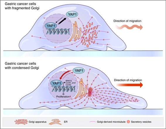 위암 세포 내 골지체의 응축된 구조 변형이 암 촉진 인자인 YAP1을 활성화해 암의 악성화를 유도하는 과정을 설명하는 모식도(2025.11.11.) ⓒ가톨릭중앙의료원 제공