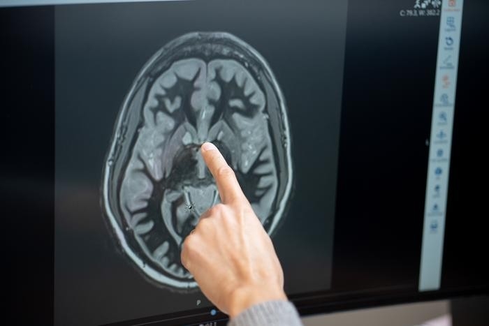 당뇨·비만 환자의 뇌 CT 영상 측좌핵 부분. 펜실베이니아대 의대 케이시 할펀 교수가 환자의 뇌 CT 영상에서 뇌 보상회로에서 핵심 역할을 하는 측좌핵(nucleus accumbens)을 가리키고 있다. ⓒ Penn Medicine 제공