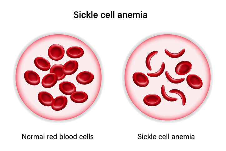 헤모글로빈 유전자 이상으로 발생하는 겸상 적혈구 빈혈증(sickle cell anemia). Ⓒ Getty Images
