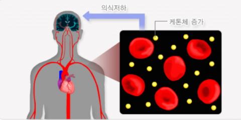 1형 당뇨병환자에게서 흔하게 나타나면서도 위급한 ‘인슐린 의존 당뇨병성 케톤산증’에서 혈중 산성도 증가로 의식 저하가 나타나는 현상으로 그림으로 나타냈다. ⓒ 국가건강정보포털