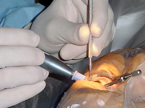 미국에서는 해마다 300만건의 백내장 수술이 이루어지고 있다. 미 해군병원에서 현미경 하 백내장 수술을 하고 있다. ⓒ Wikipedia / U.S. Navy photo by Journalist 2nd Class Sarah Langdon