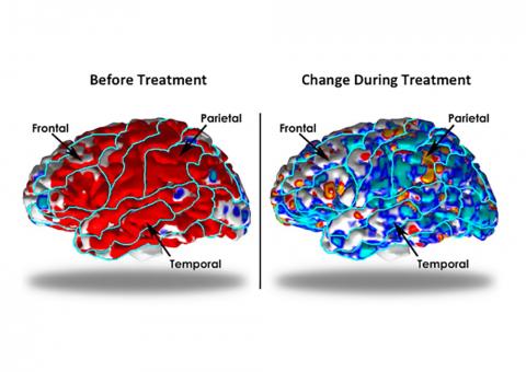 만성 우울증 환자의 치료 전과 치료 중 MRI 뇌 스캔 사진. 왼쪽 사진에서 치료 전 우울증 환자의 뇌는 전두엽과 측두엽, 정수리엽의 피질이 두꺼운 것으로 나타났으나(빨간색), 약 10 주간의 약물 투여 후 그 부위들의 피질 두께는 건강한 대조군과 비슷하게 바뀌었다(오른쪽 파란색). Credit: Ravi Bansal, PhD