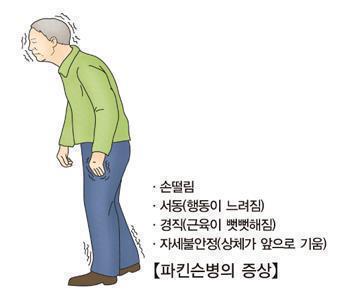 파킨슨병 ⓒ서울아산병원 제공
