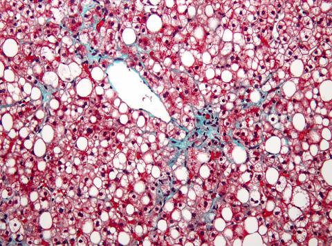 비알코올성 지방간 질환의 현미경 조직 사진. 흰색이 지방간 조직이다.  Credit: Wikimedia Commons / Nephron