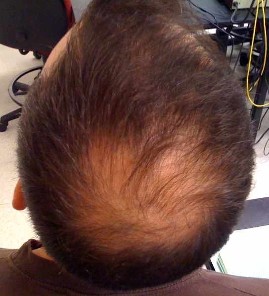 Can “hair loss” science conquer it?  – Sciencetimes