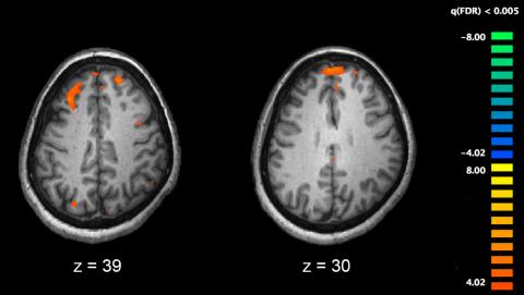 fMRI 촬영 연구 결과 기억을 하는 과업에서 조현병 환자의 뇌 영상(우)은 정상인의 뇌 영상(좌)에 비해 덜 활성화된 모습을 보여준다 ⓒ Kim J, Matthews NL, Park S(Wikipedia)