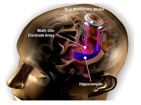 스타트업 커널의 뇌 보철 개념도. 해마에 전극을 심어 정보를 장기 기억으로 전환한다. ⓒ 커널