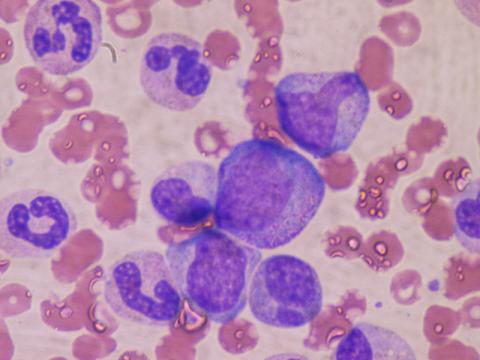 조혈 전구세포들. 가운데는 전골수구(proyelelocyte), 옆에 두 개의 후골수구(metamyelocyte)가 있고, 골수에서 흡인한 밴드 세포들이 있다. Credit: Wikipedia Commons