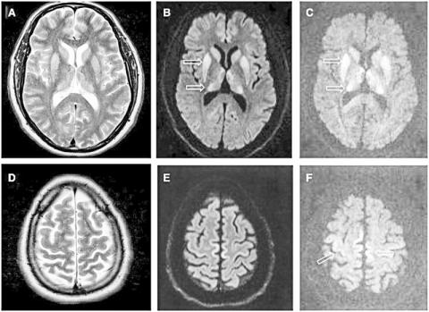 성장호르몬 때문에 CJD에 걸린 46세된 환자의 뇌 MRI 사진. CJD를 일으킬 수 있는 결함 있는 단백질은 오염된 인체 뇌 관련 제품과 각막 이식편, 뇌경막 이식편, 전극 임플란트와 인간성장호르몬 등에 의해 전파될 수 있다. Credit:Wikimedia Commons/https://www.ncbi.nlm.nih.gov/pmc/articles/PMC4620512/figure/awv235-F2/