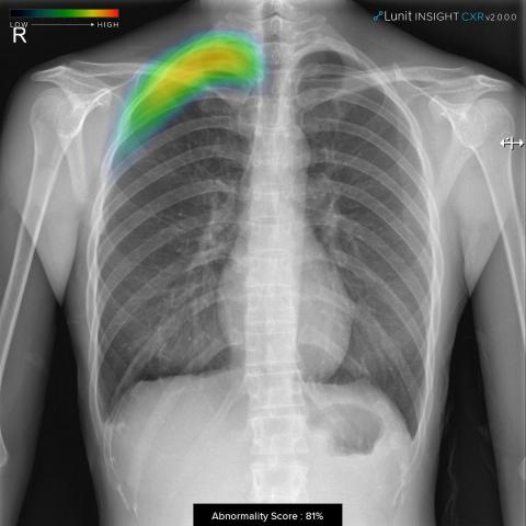 루닛 인사이트(Lunit INSIGHT) CXR 2로 검출한 기흉 케이스. 히트맵(heatmap) 형태로 병의 유무 및 위치를 표시해 의사들의 효율적이고 정확한 판단을 돕는다. ⓒ 루닛루닛 인사이트(Lunit INSIGHT) CXR 2로 검출한 기흉 케이스. 히트맵(heatmap) 형태로 병의 유무 및 위치를 표시해 의사들의 효율적이고 정확한 판단을 돕는다. ⓒ 루닛